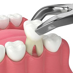 a 3D depiction of a tooth extraction